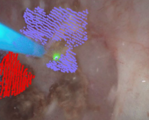 kidney_stone.png